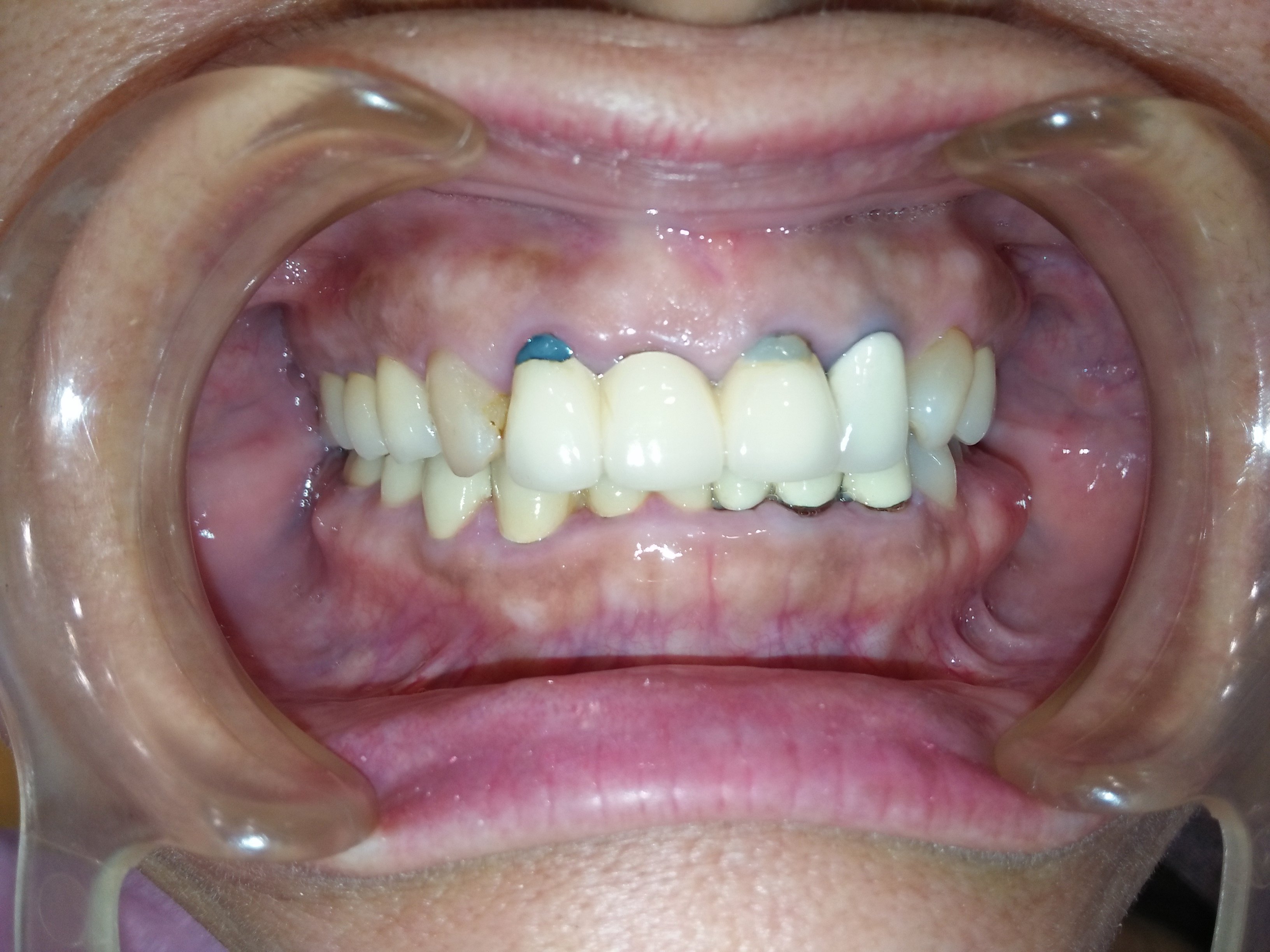 經常性蛀牙，該如何修復呢？？