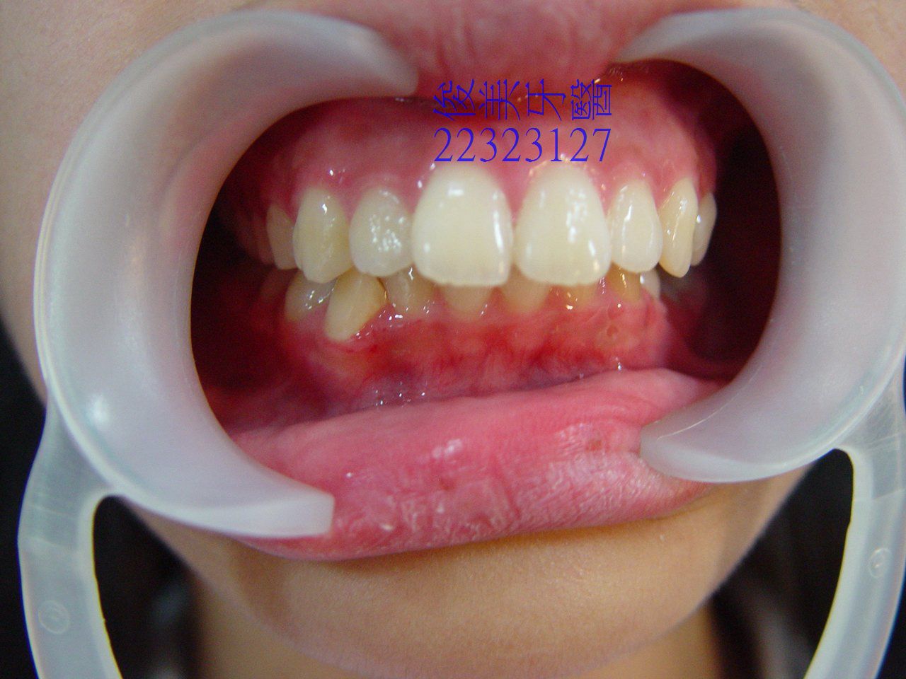 牙齒變黑了怎麼辦？part V：牙根變色，但內有個大鑄釘，拿下來牙根傷害太大 - 牙科美容資訊 - 美容牙科張凱榮醫師