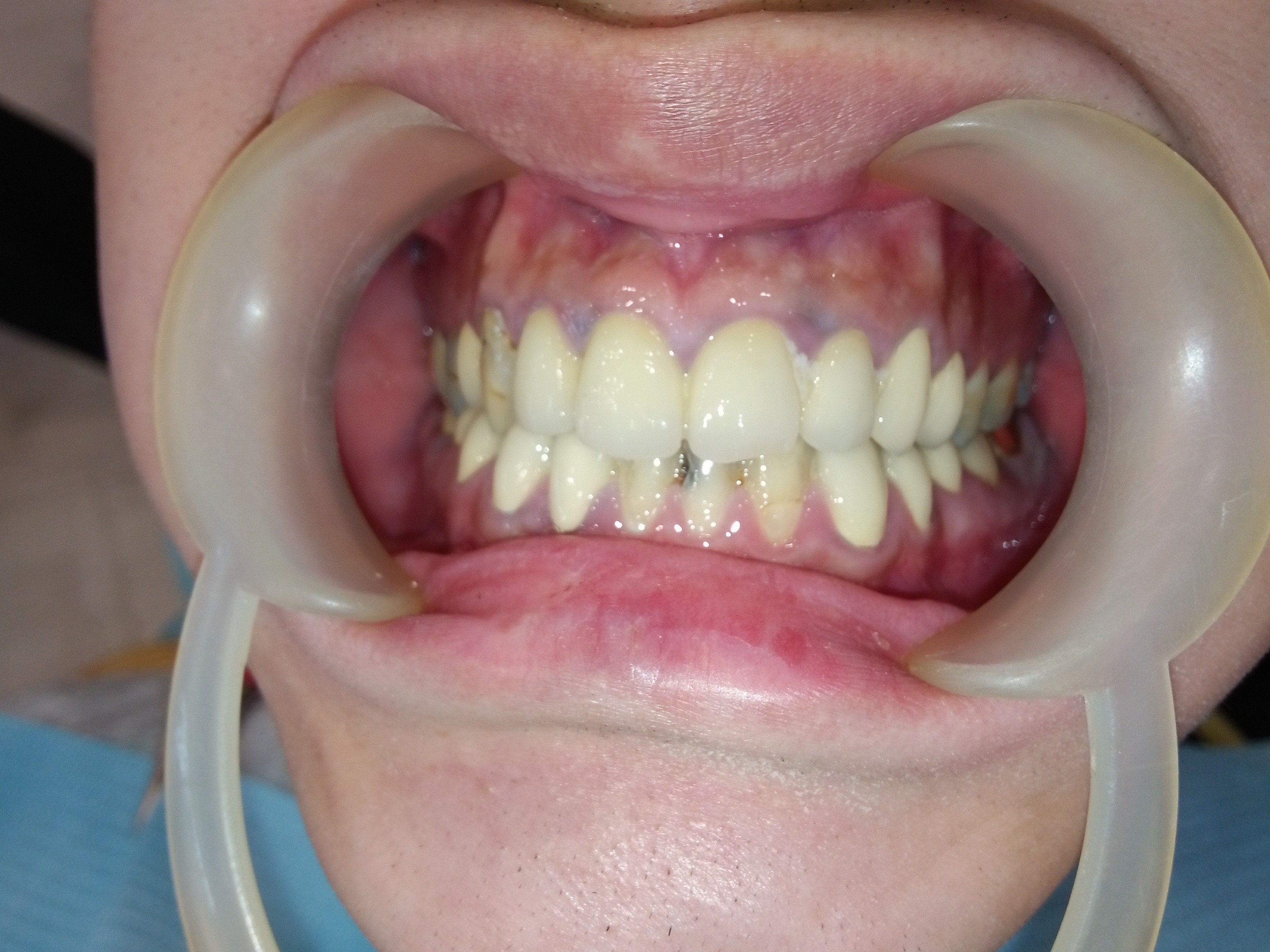 經常性蛀牙，該如何修復呢？？